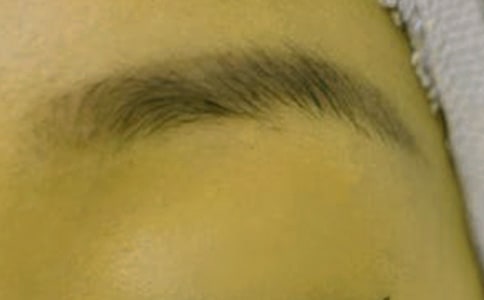 眉毛上长痘痘的原因
