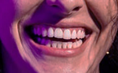 孕妇牙龈肿痛有四个原因